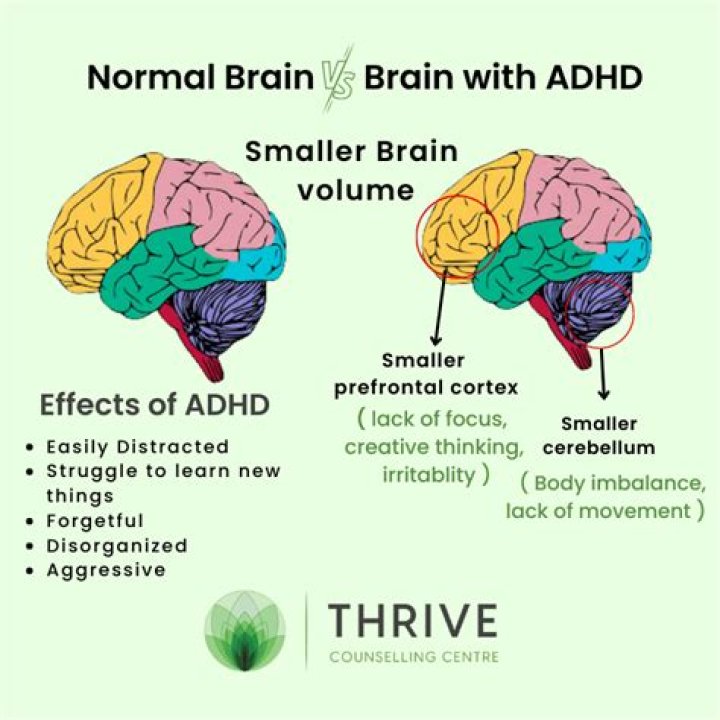 Are ADHD people left or right brain?