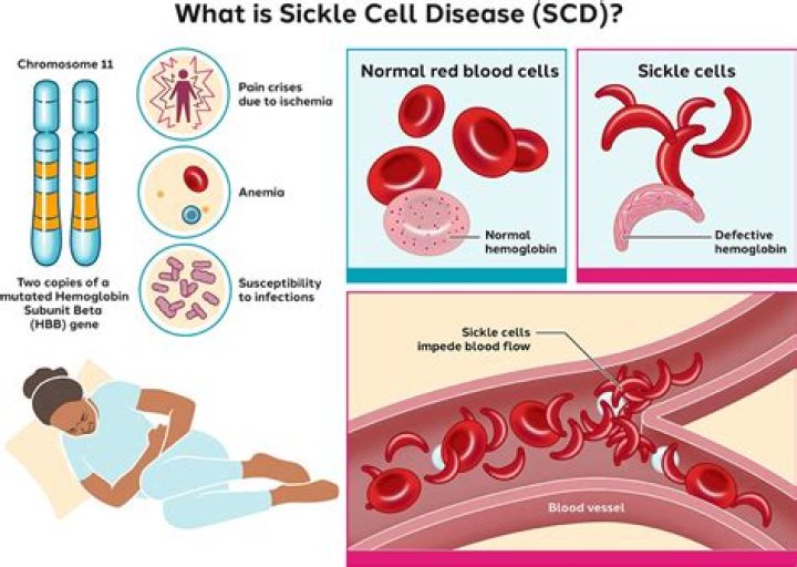 At what age does sickle cell manifest?