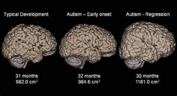 Can a brain scan show autism?