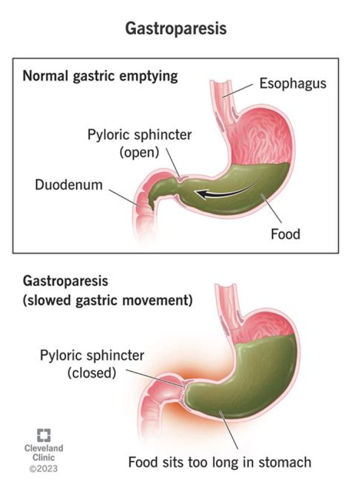 Can a paralyzed stomach be fixed?