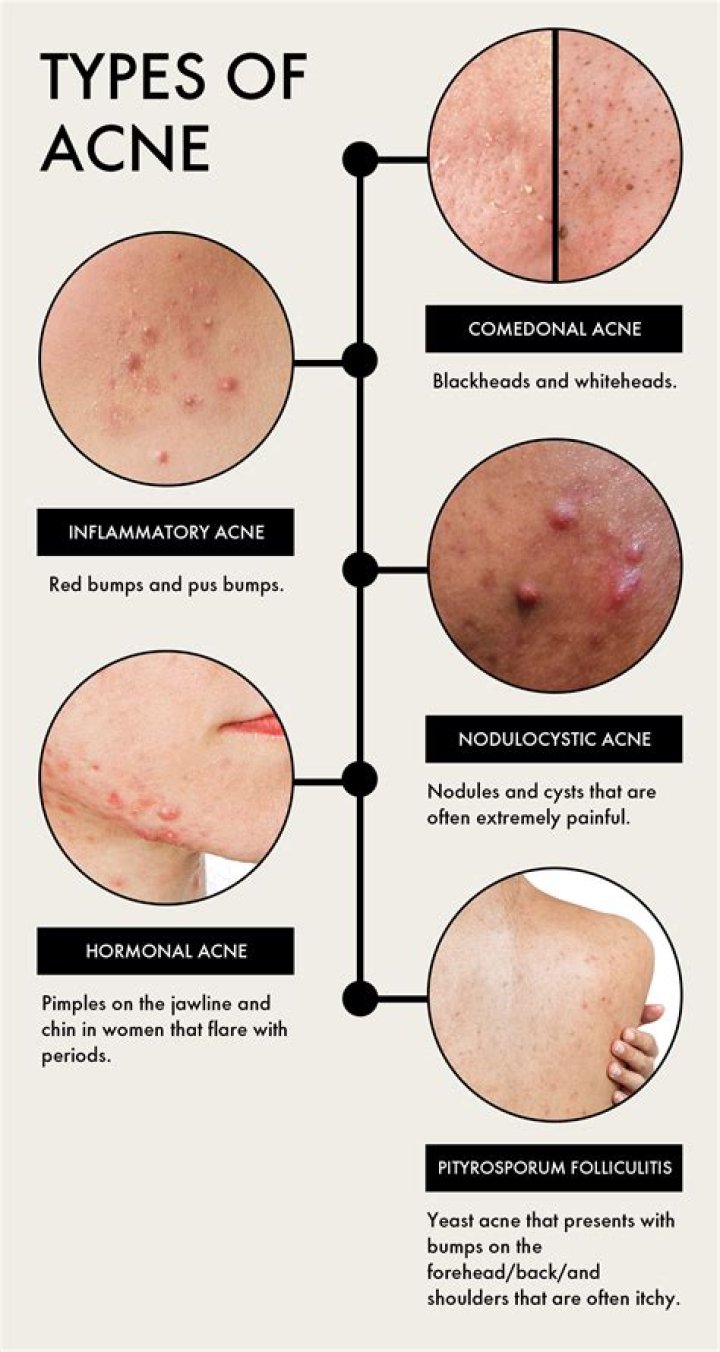 Can acne clear up on its own?
