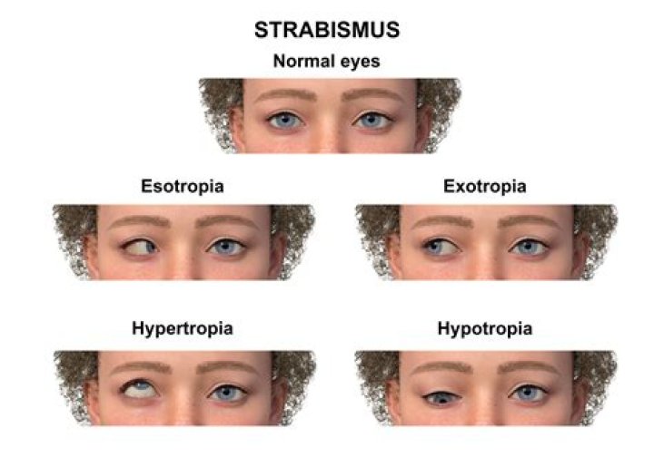 Can an eye patch fix strabismus?