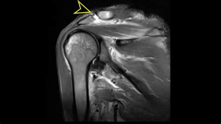 Can an MRI show inflammation?