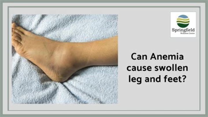 Can anemia cause weak legs?