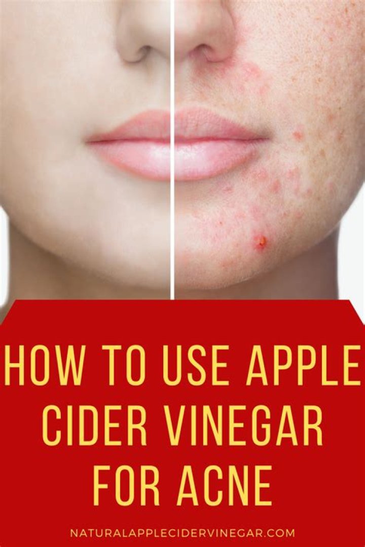 Can apple cider vinegar make acne worse?