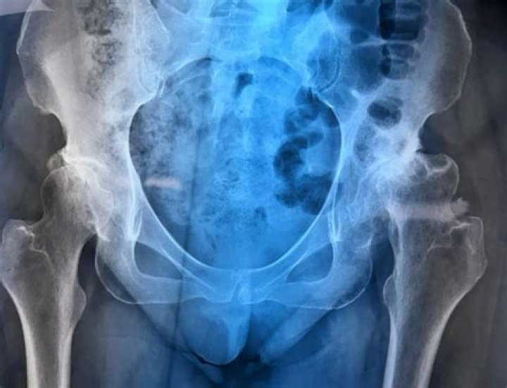 Can hip replacement be done outpatient?