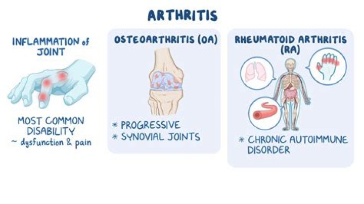 Can I get rheumatoid arthritis at 26?