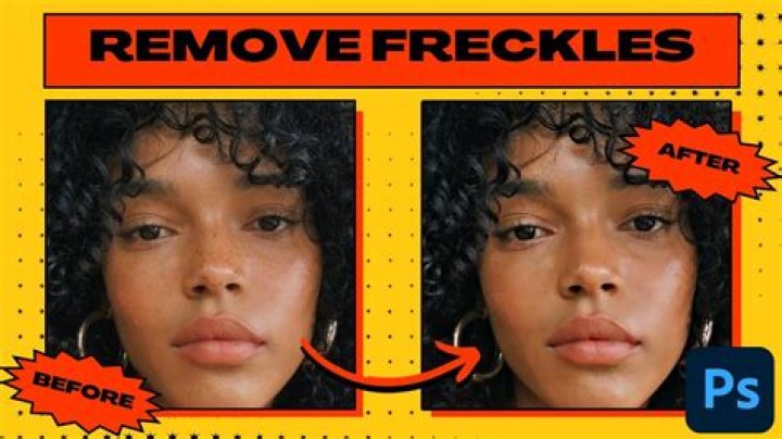 Can I remove my freckles?