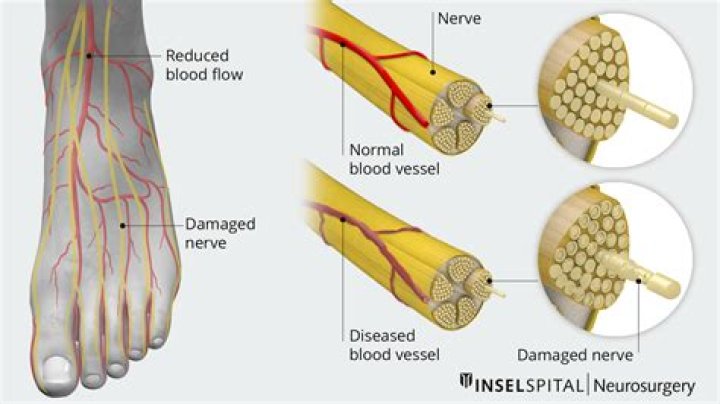 Can nerve damage in feet be fixed?