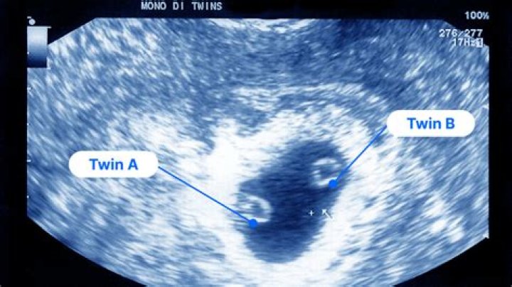 Can one twin survive a miscarriage?