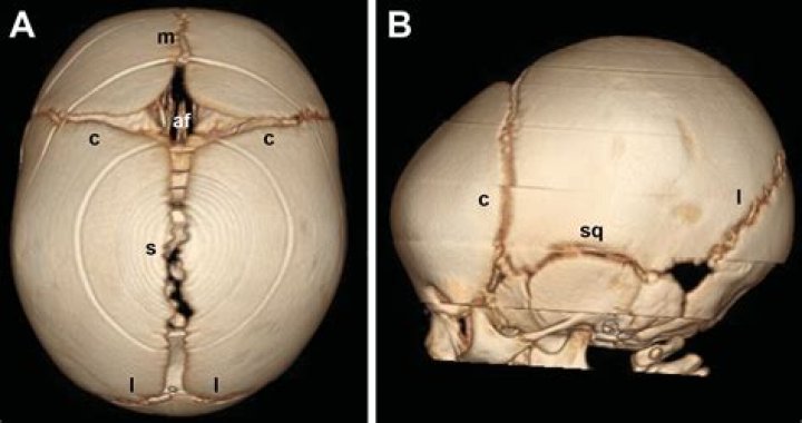 Can you feel coronal suture?