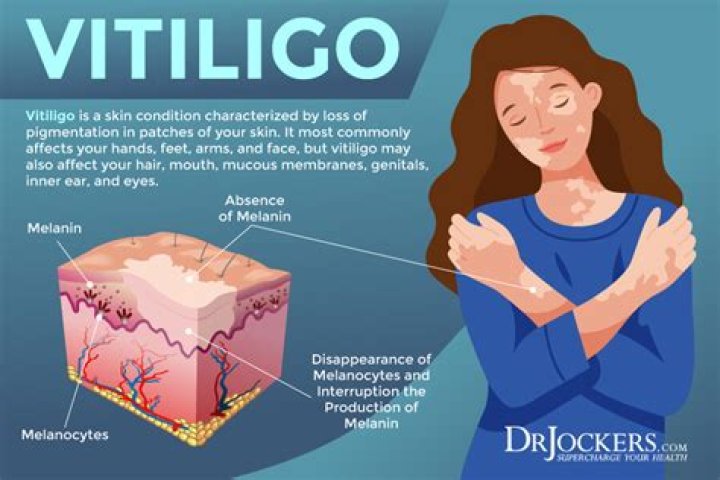 Can you have mild vitiligo?