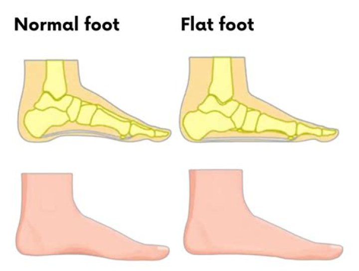 Do flat feet get worse with age?