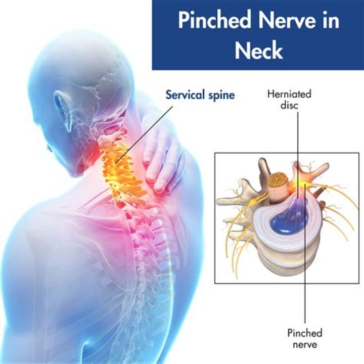 Does a pinched nerve in neck qualify for disability?