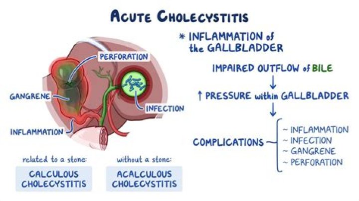Does acute cholecystitis require surgery?