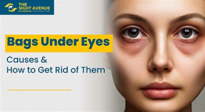 Does anxiety cause eye bags?
