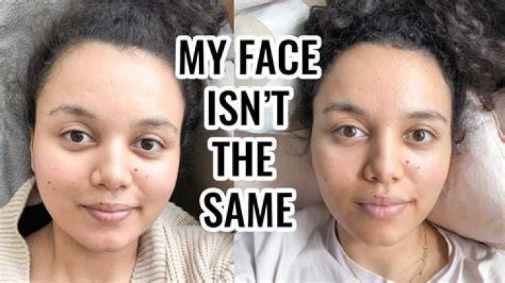 Does baby face go away?