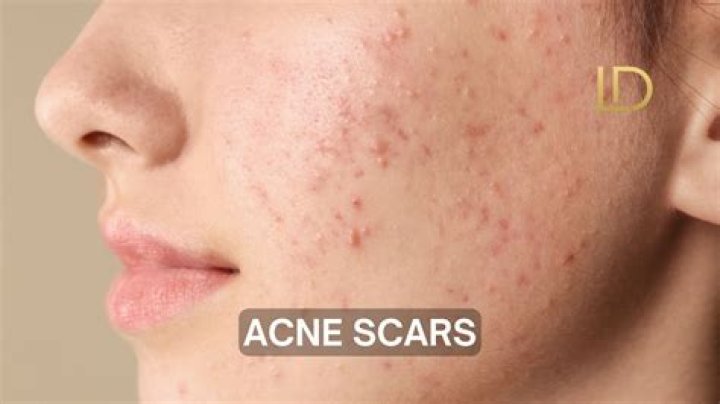 Does love cause acne?