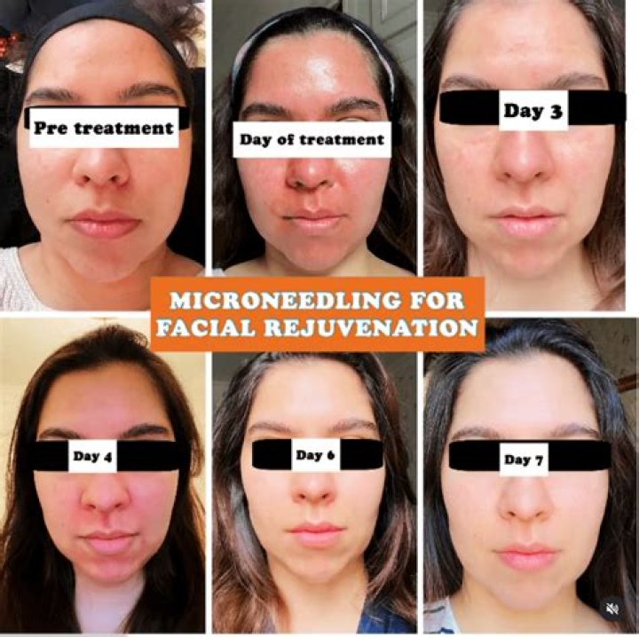 Does microneedling improve complexion?