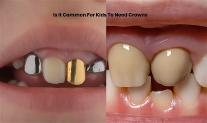 Does my 5 year old need crowns?