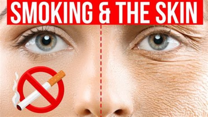 Does smoking cause pimples on face?