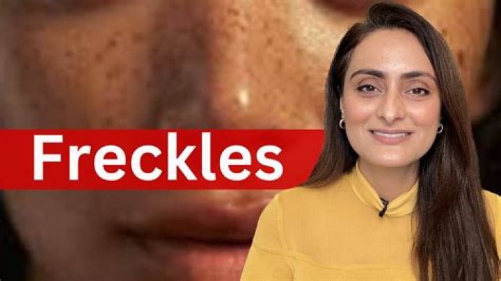 How are freckles caused?