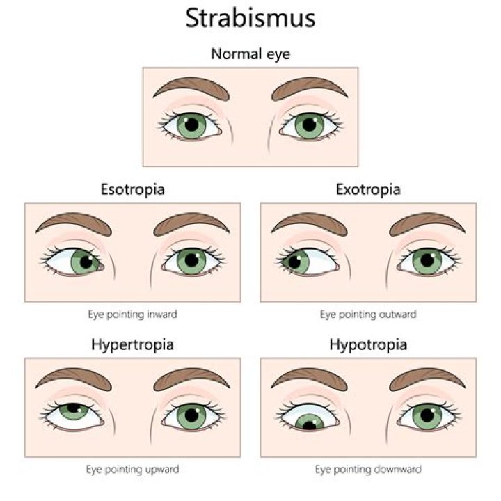 How common is strabismus in the world?