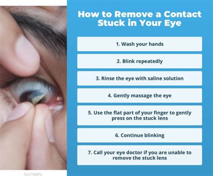 How do doctors remove stuck contact lens?
