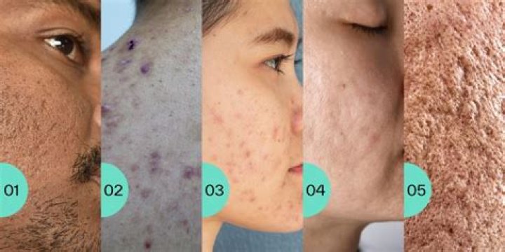 How do I know if my acne scars are permanent?