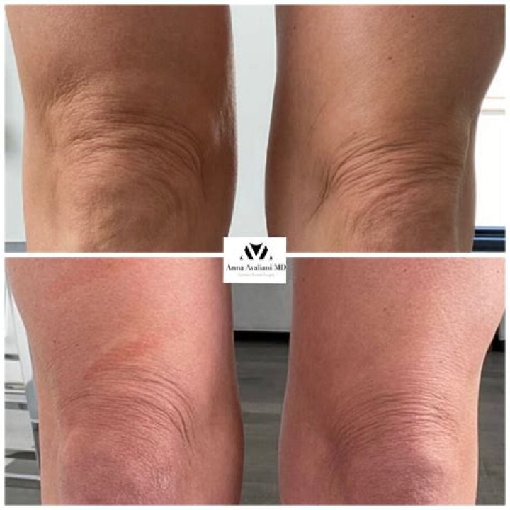 How do you reverse knee wrinkles?