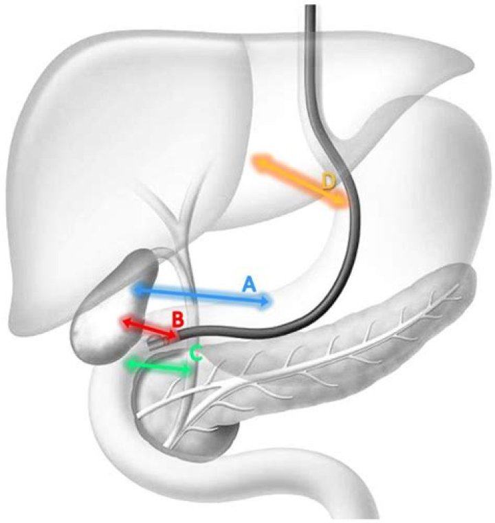 How do you test for biliary obstruction?