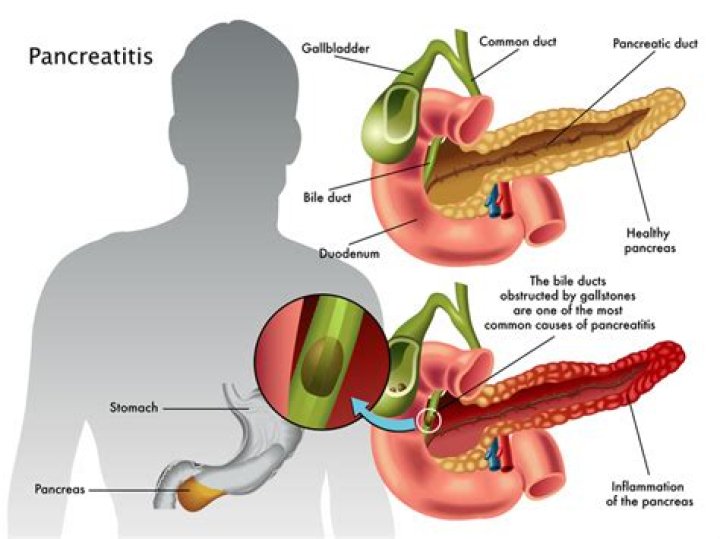 How does a doctor diagnose pancreatitis?