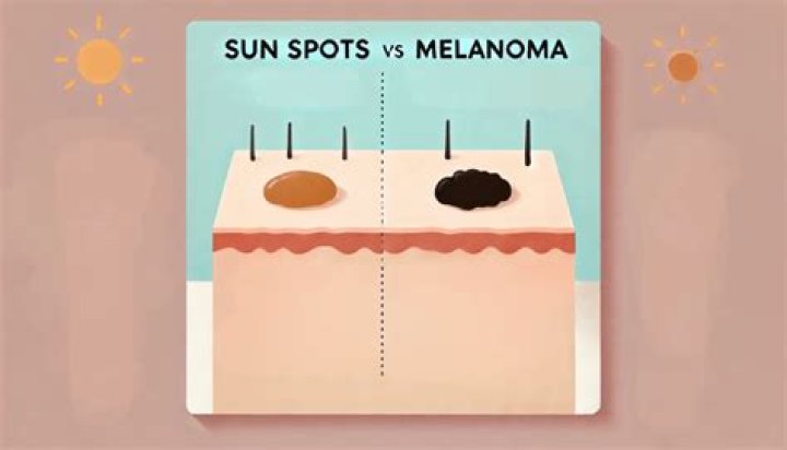 How long does a sun spot last?