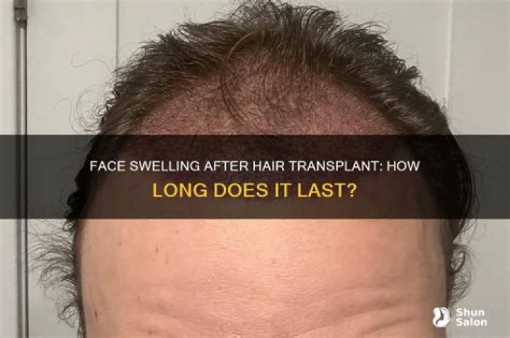 How long does face swelling last?