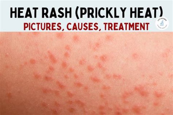 How long does heat rash take to heal?