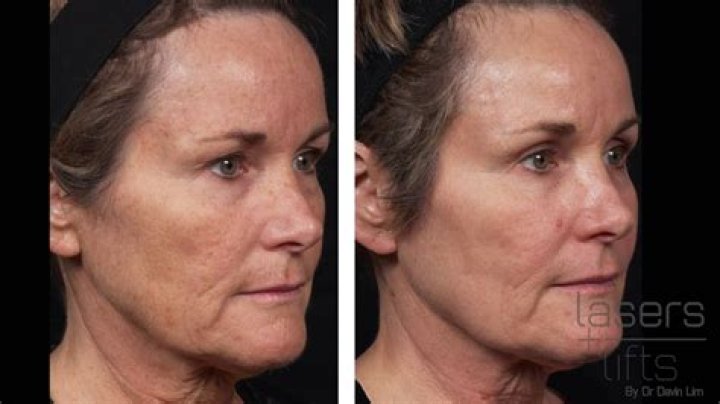How long does it take skin to heal?