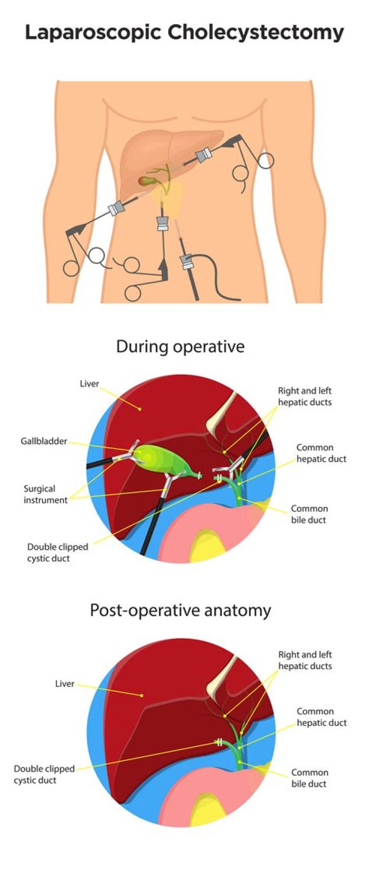 How long does open gallbladder surgery take?