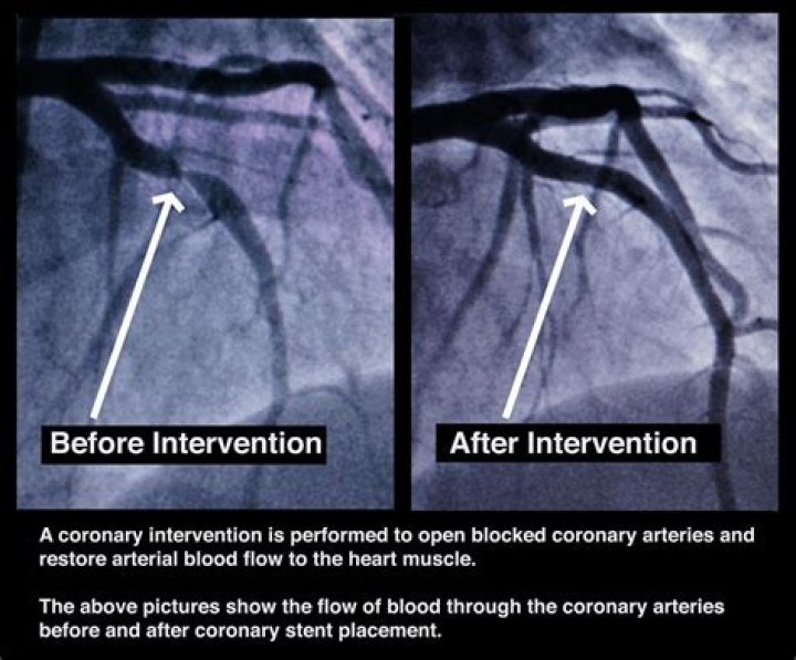 How often should a heart stent be checked?
