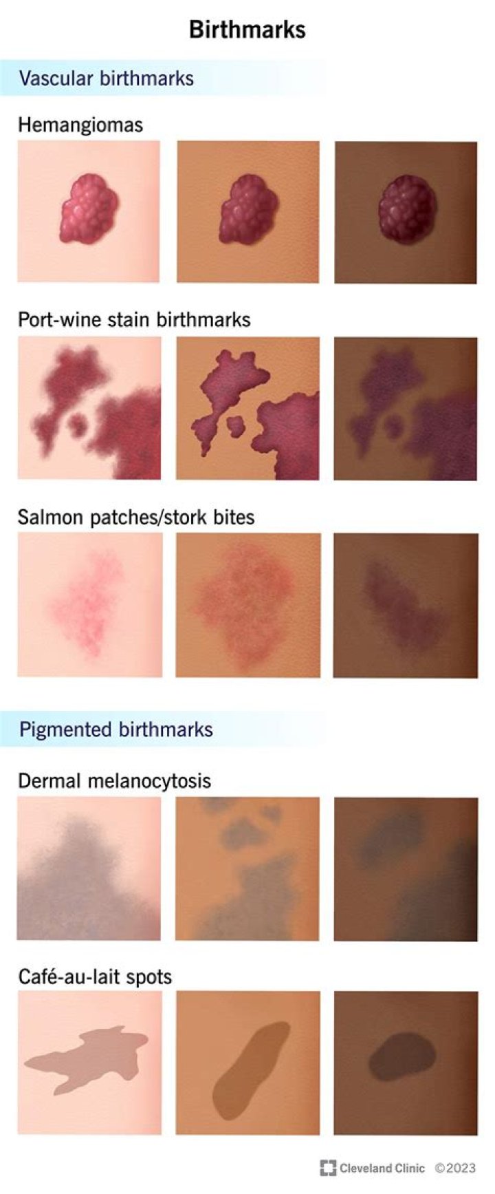 How rare is a red birthmark?