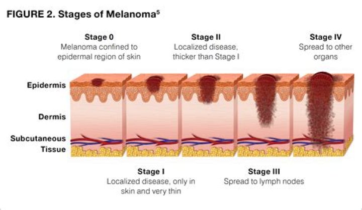 Is a melanoma painful?