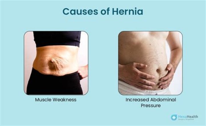 Is an abdominal hernia serious?