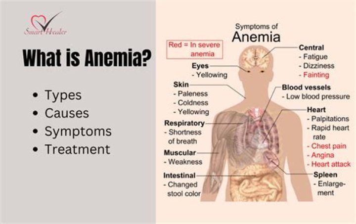 Is anemia linked to autism?