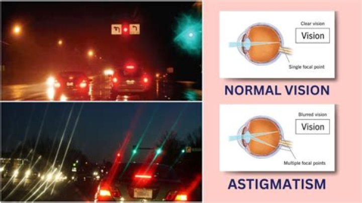 Is astigmatism caused by stress?