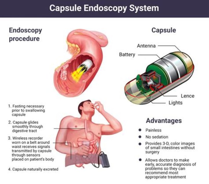 Is capsule endoscopy better than normal endoscopy?