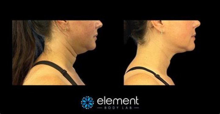 Is CoolSculpting permanent?