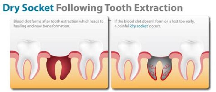 Is dry socket a dental emergency?
