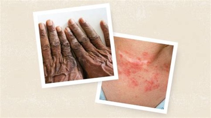 Is eczema linked to other diseases?