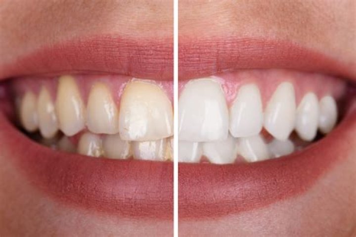 Is it worth it to get teeth whitened?
