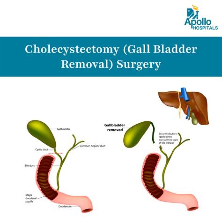 Is life normal after gallbladder removal?