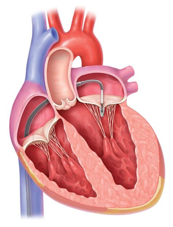 Is MitraClip open-heart surgery?